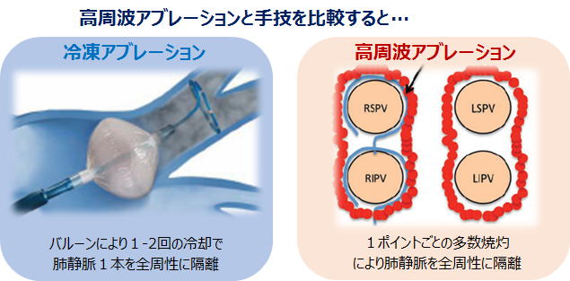 カテーテル アブレーション 費用