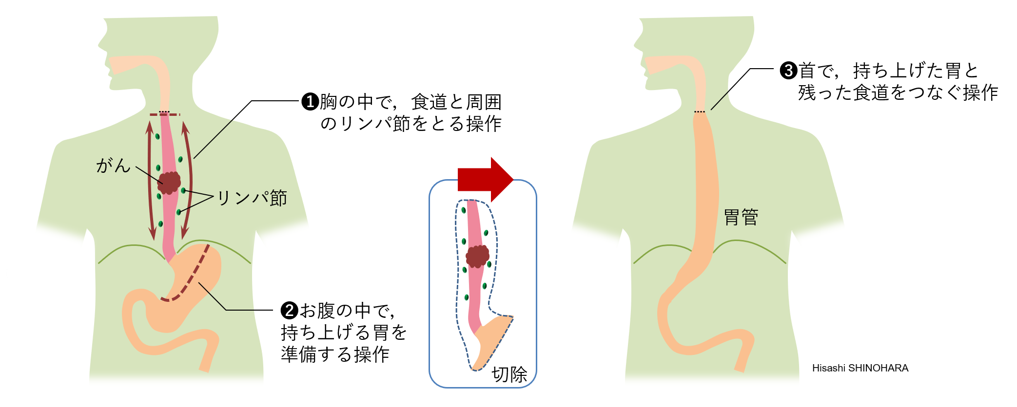 麻痺 神経 反 回