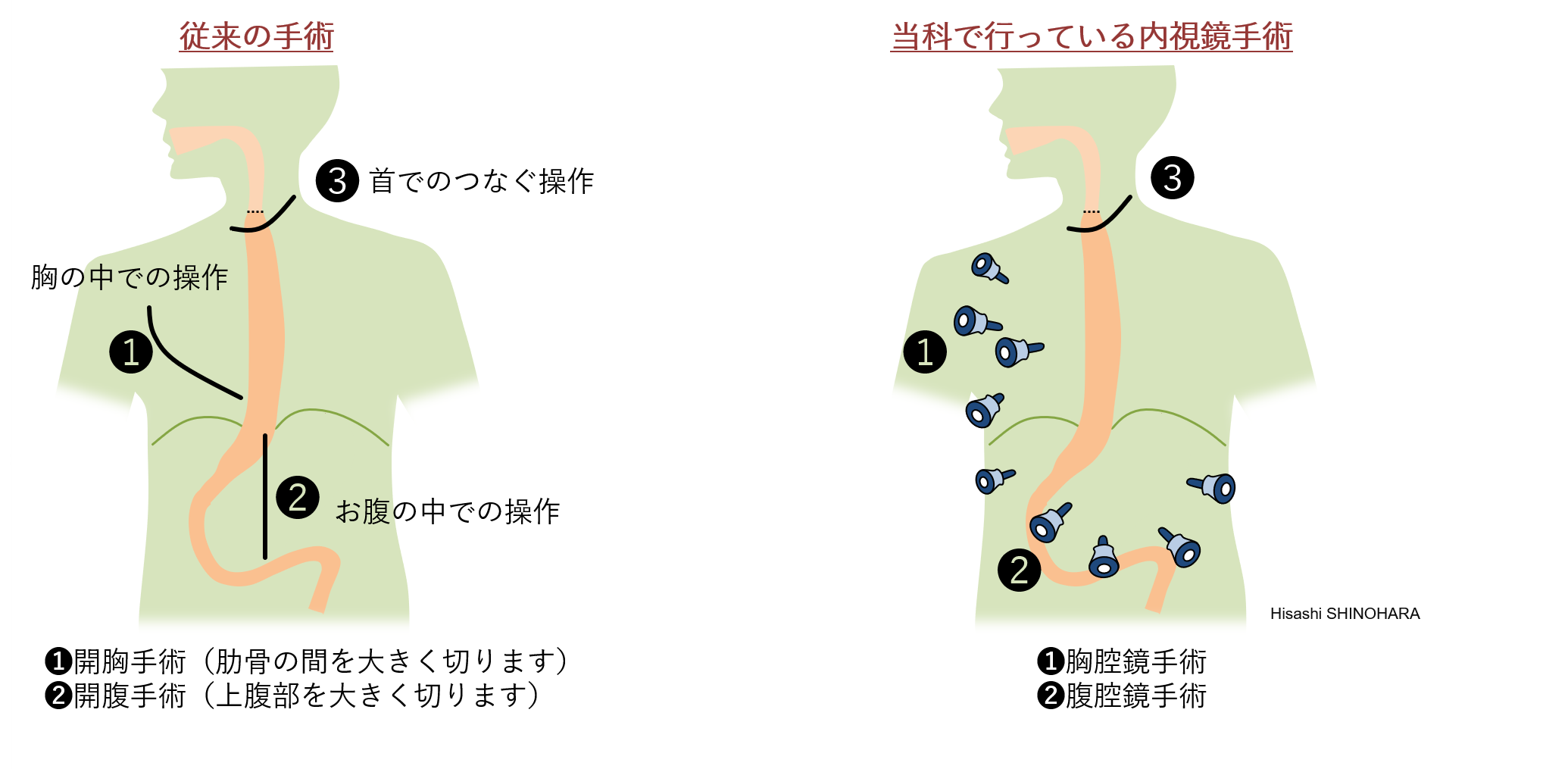 麻痺 神経 反 回