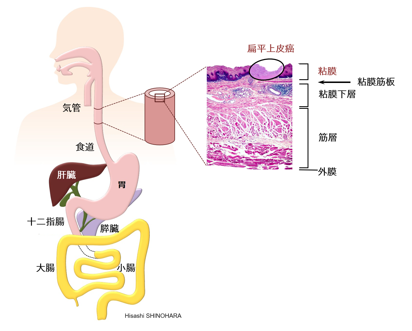 神経 麻痺 回 反
