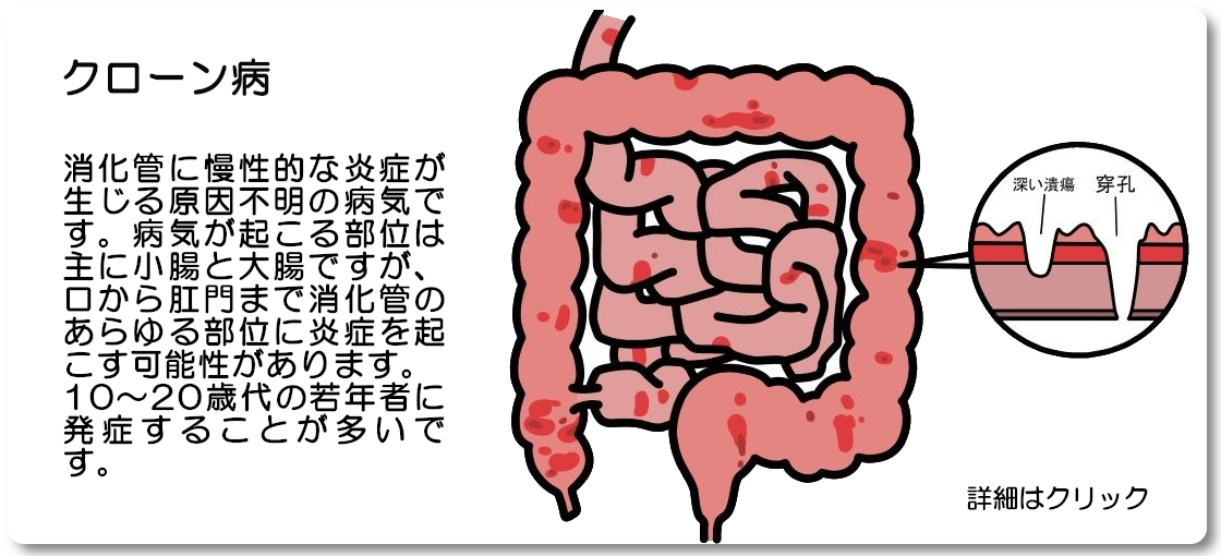 クローン病について