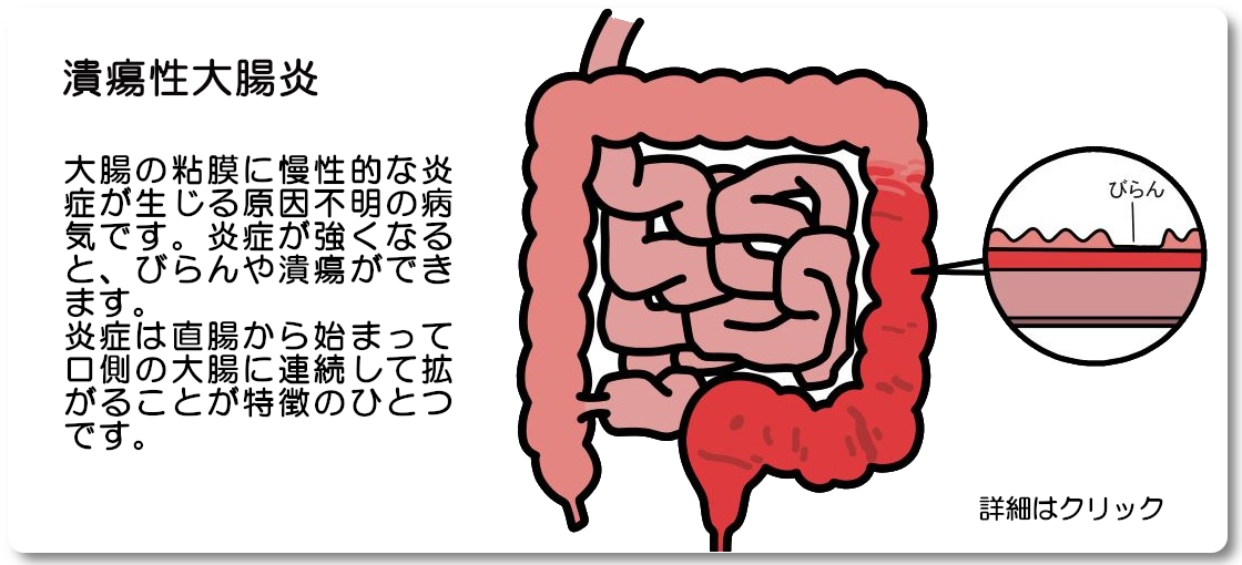 潰瘍性大腸炎について